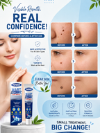 Wart Remover Ointment